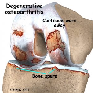 osteo arthritis