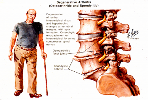 arthritis in the spine