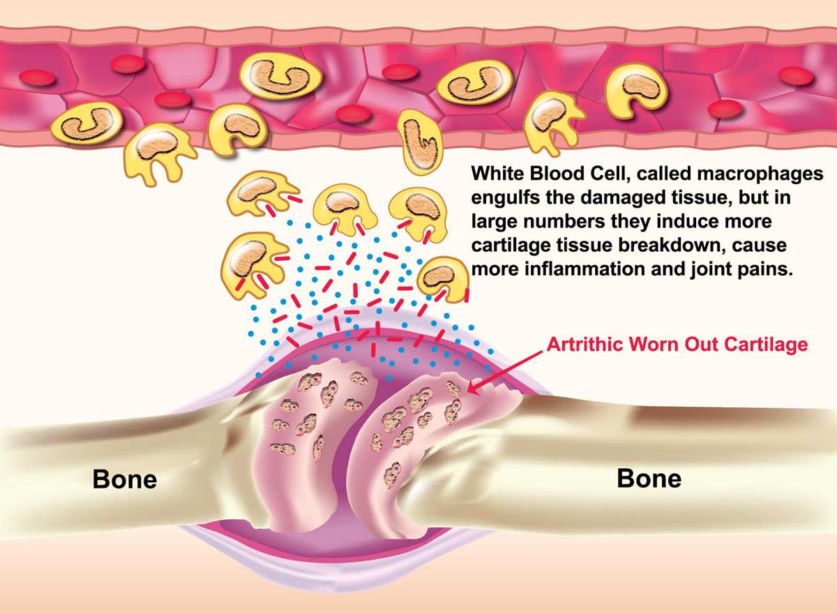 joint inflammation