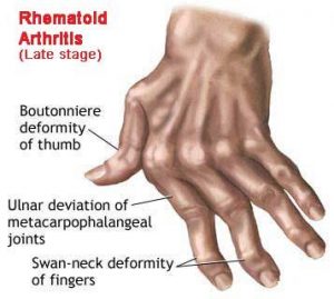 rheumatoid arthritis relief