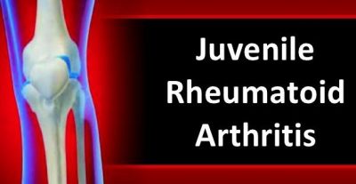 treatment for juvenile arthritis