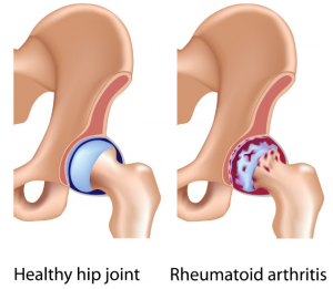 rheumatoid arthritis hip 