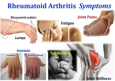 what are the symptoms of rheumatoid arthritis