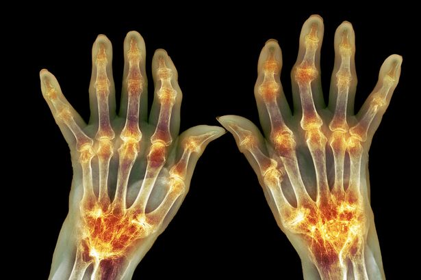 arthritis in the hands symptoms