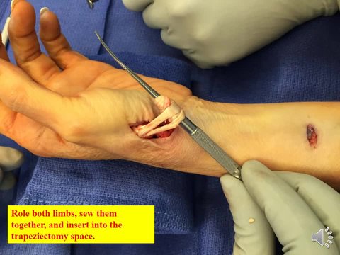 thumb surgery for arthritis