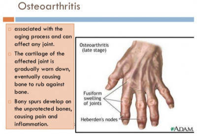 osteoarthritis of the hands