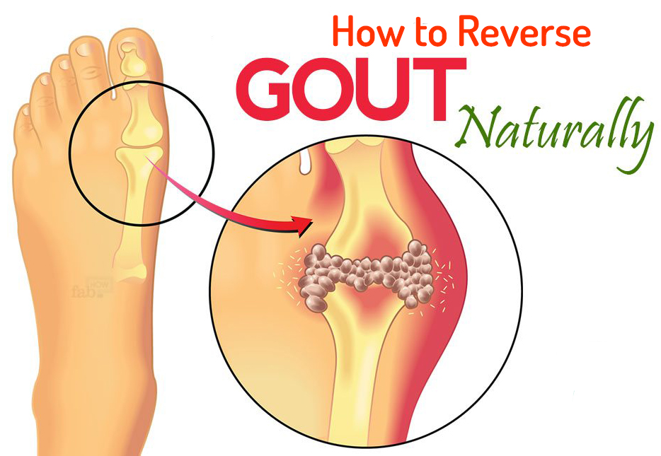 natural gout remedy