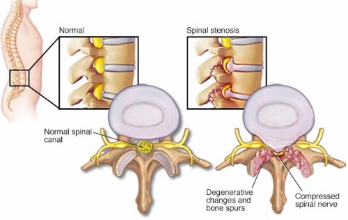 spinal stenosis cause
