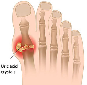 how to lower uric acid
